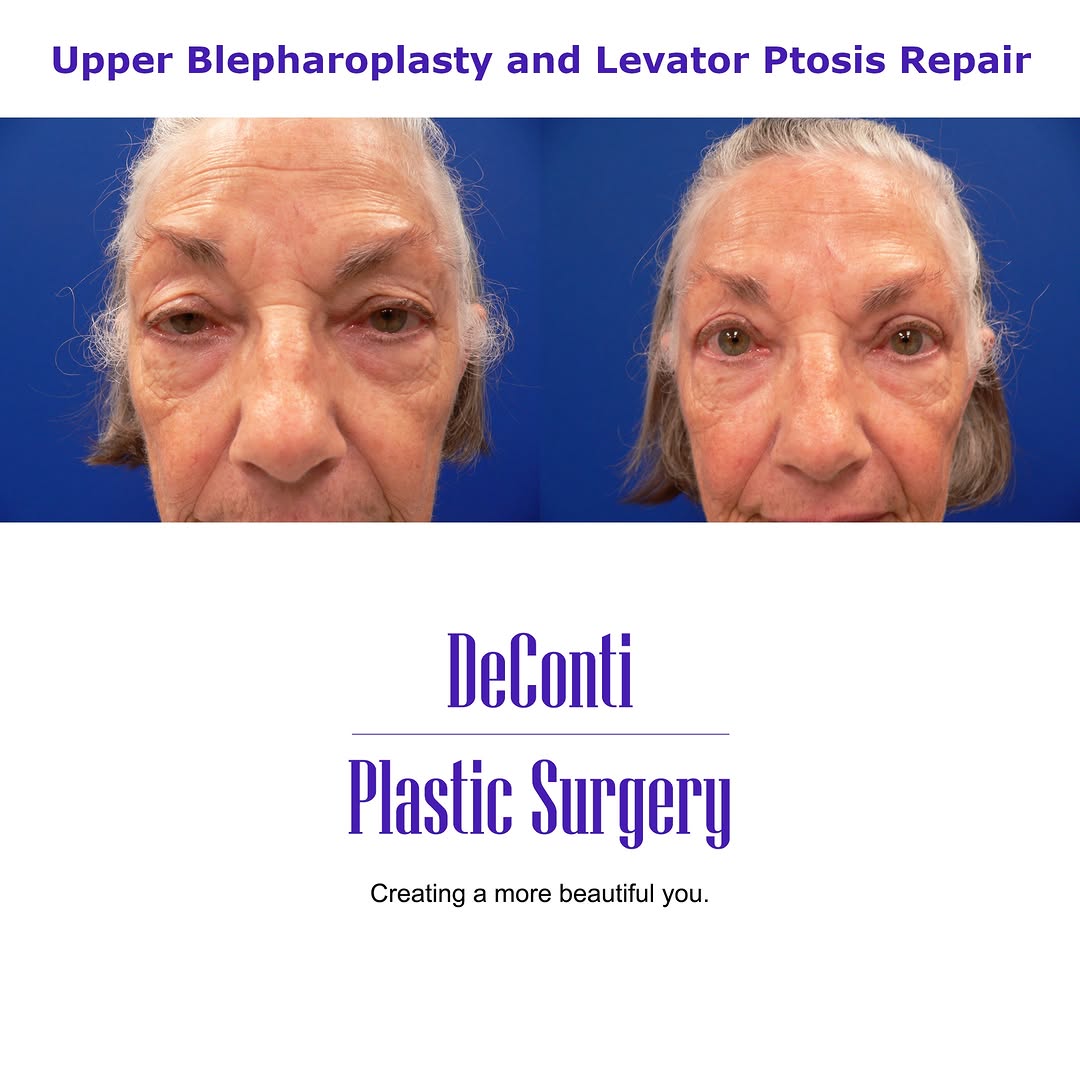 Instagram post by Dr. Robert W. DeConti: It’s not just about excess skin—it’s about function, symmetry, and how you see yourself in the mirror. ✨👀 Upper blepharoplasty + levator pt…