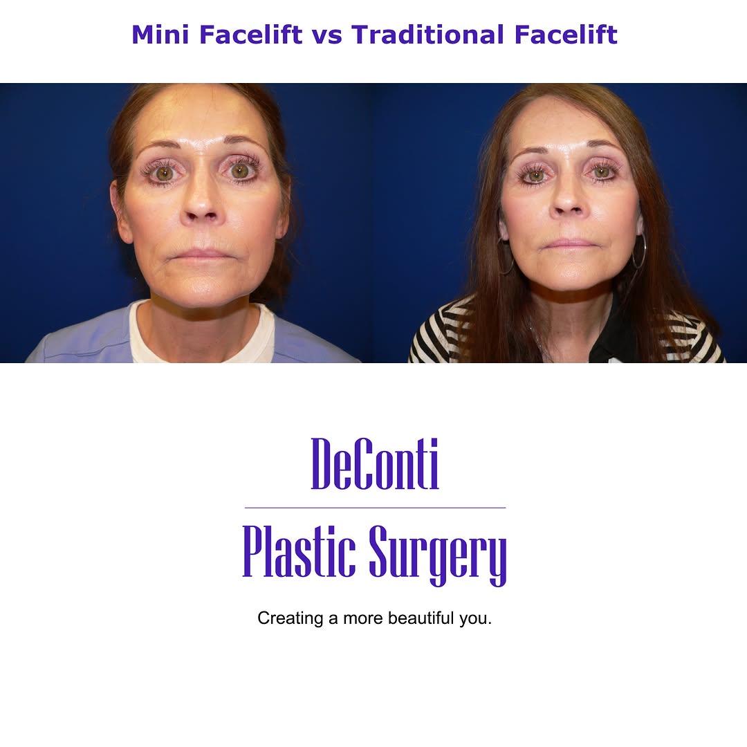 Instagram post by Dr. Robert W. DeConti: Not all facelifts are created equal. Here’s the quick breakdown: 👇 🟢 Mini Facelift • Smaller incisions around the ear • Targets lower face…