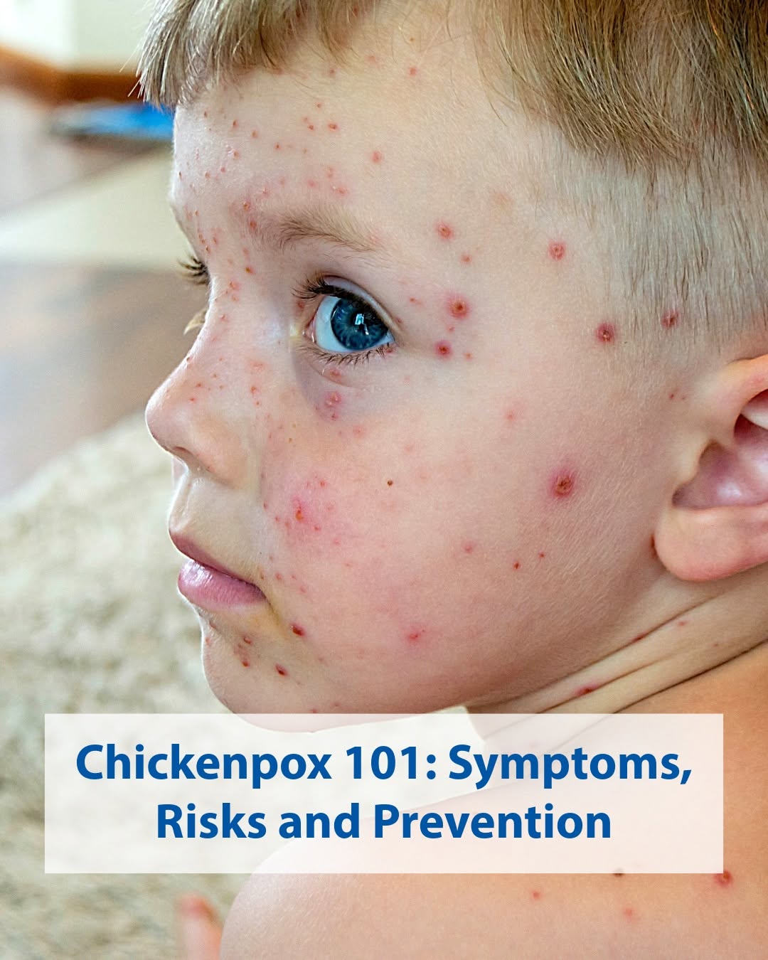Instagram post by Dr. Robin Evans: Although chickenpox is much less common today, questions about the disease and its potential risks remain. To help parents and caregivers be…