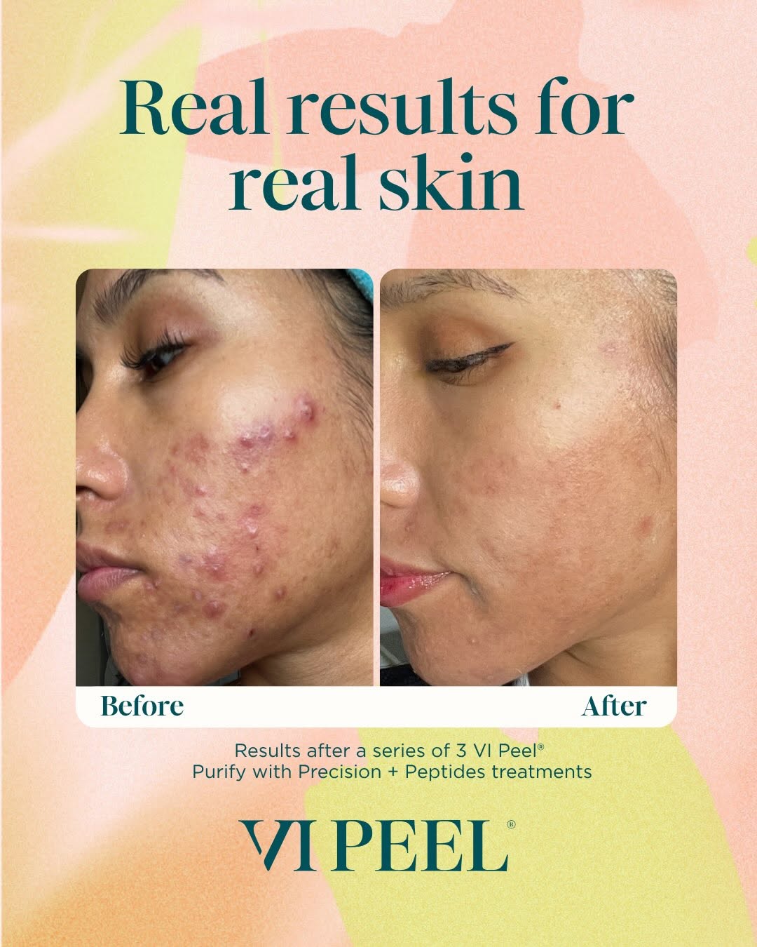 Instagram post by Dr. Robyn Daugherty: ✨ Peel your way to clearer skin ✨ Our VI Peel treatments offered in-office are a great option for improving the appearance of active acne, a…