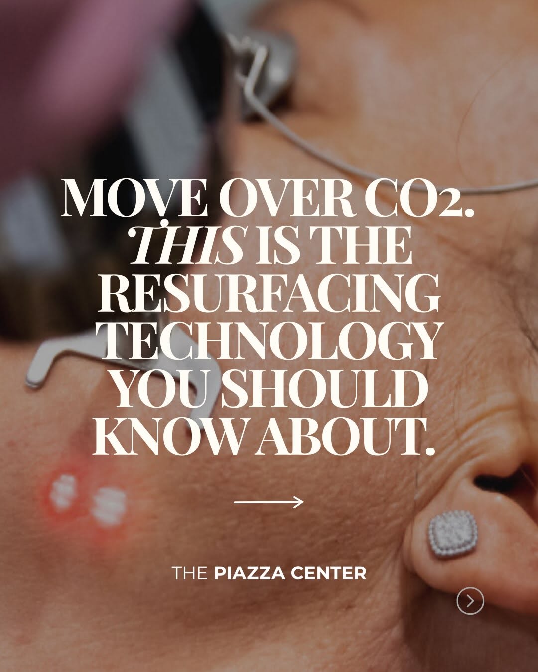 Instagram post by Dr. Rocco C. Piazza: CO₂ laser resurfacing gets a lot of attention, but it’s no longer the only option for patients seeking smoother texture, improved acne scars…