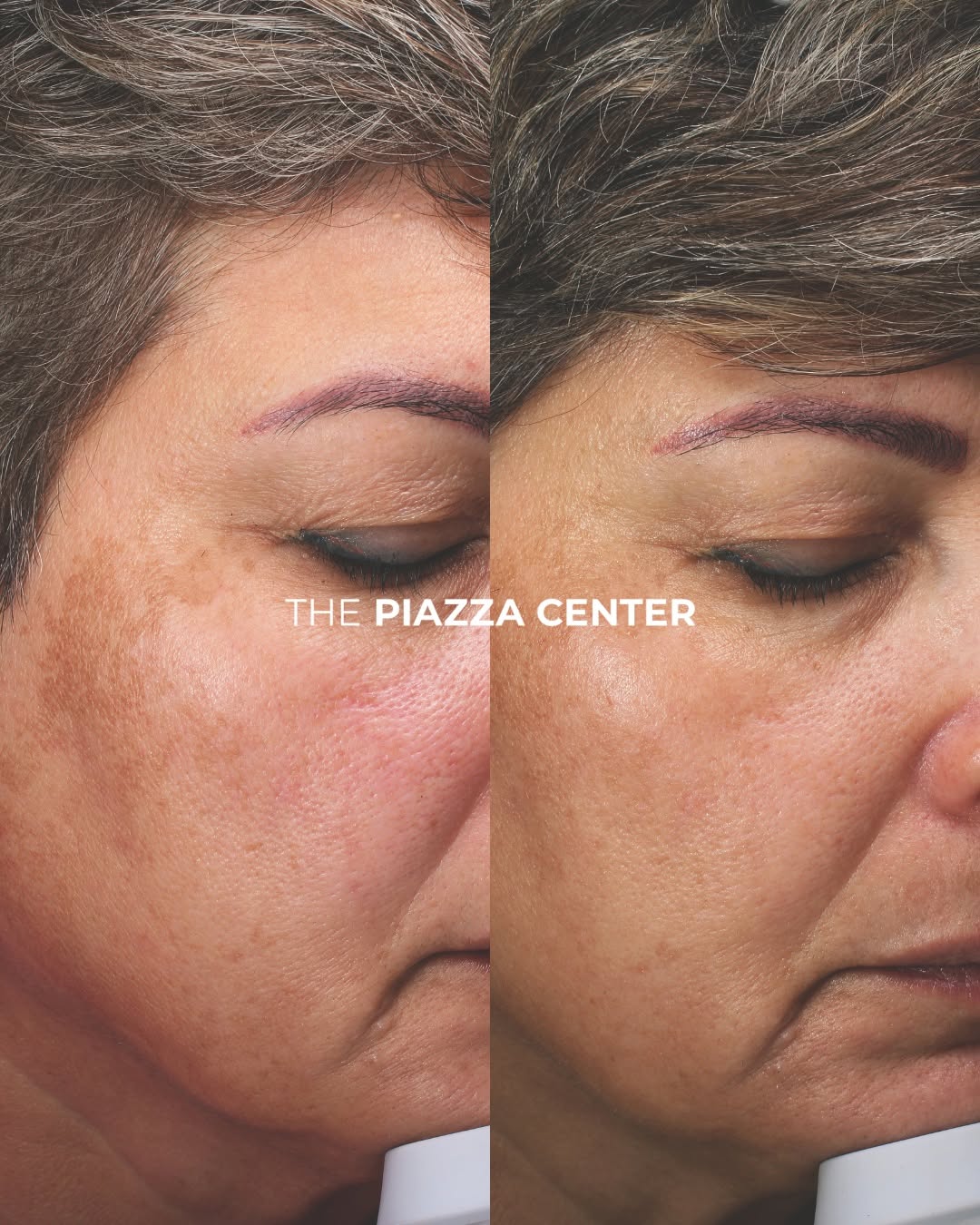 Instagram post by Dr. Rocco C. Piazza: This patient’s TruSkin Age doesn’t just look younger. It measures younger. Her current TruSkin Age is 4 years younger than her actual age, a…