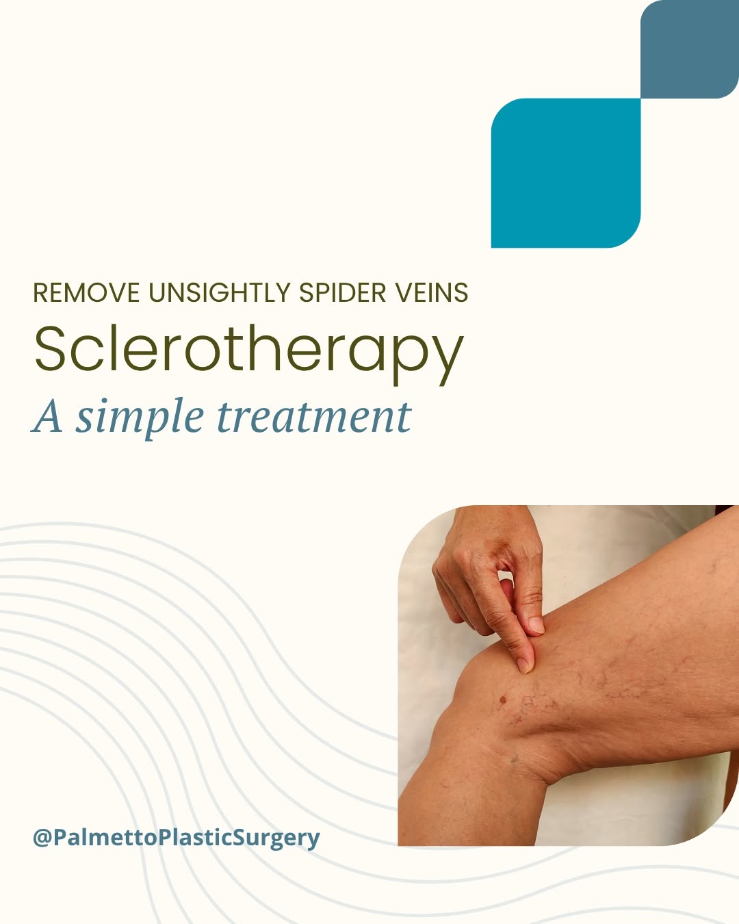 Instagram post by Dr. Rodney Young, III: Smoother-looking legs can be simpler than you think. 💯 With sclerotherapy, Dr. Rodney Young can treat unwanted spider veins with a simple, …