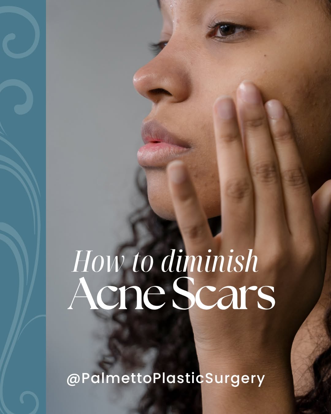 Instagram post by Dr. Rodney Young, III: Smoother, more even-looking skin starts with the right treatment plan. Depending on your skin and the type of scarring you have, these treat…