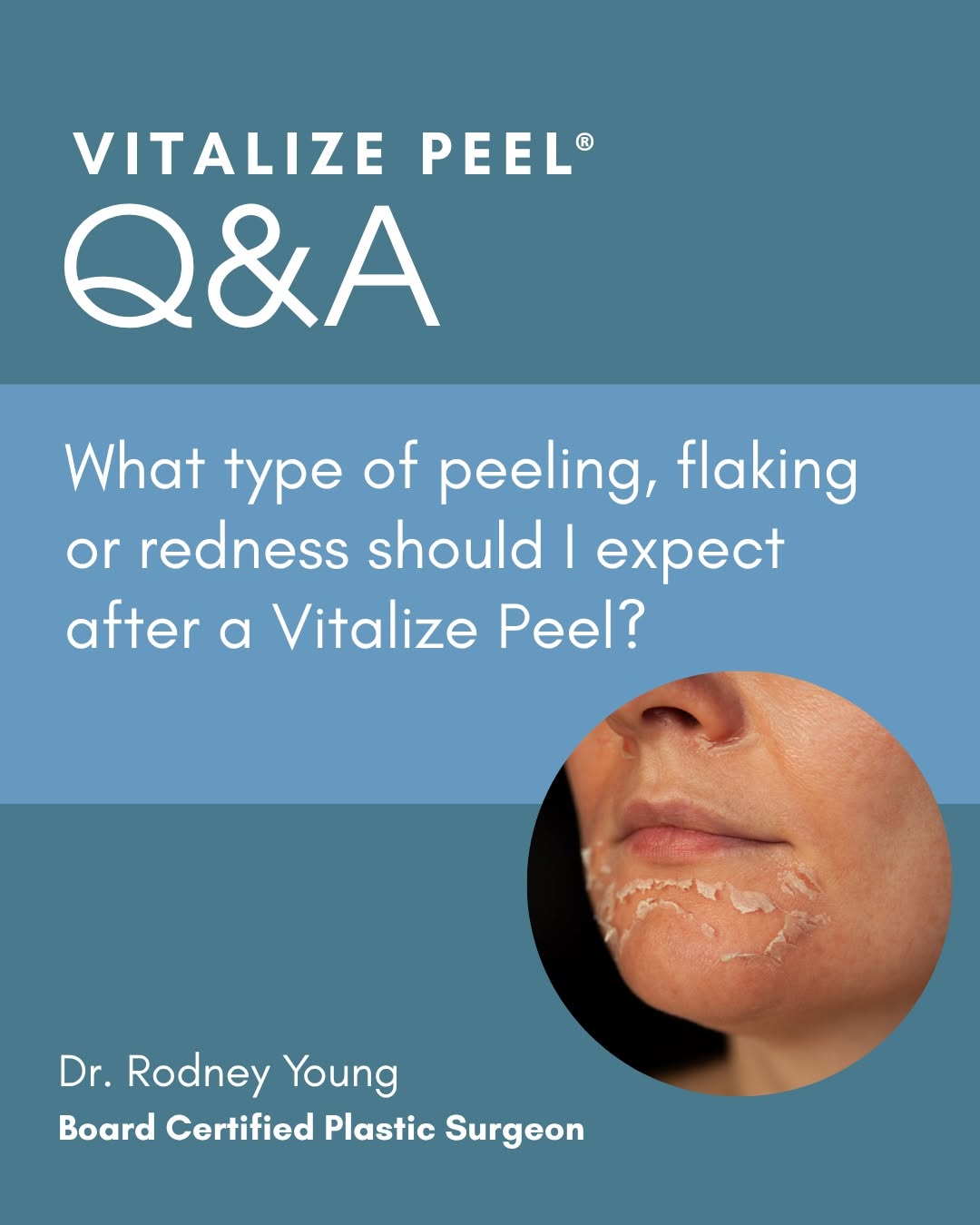 Instagram post by Dr. Rodney Young, III: One of the most common questions we hear after a Vitalize Peel® is, "When am I actually going to start peeling?" You may notice some mild re…