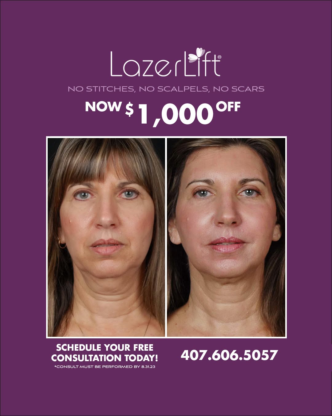 Instagram post by Dr. Roger Bassin: Now offering $1000 off LazerLift® for a limited time only! LazerLift’s advanced laser technology restores youthful contours to the face and …