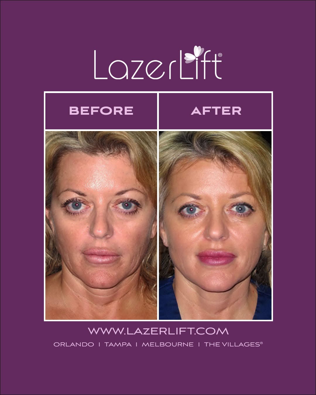 Instagram post by Dr. Roger Bassin: Tighten and lift the skin with LazerLift® for amazing results! Check out these before and after images of LazerLift®. LazerLift® targets the…