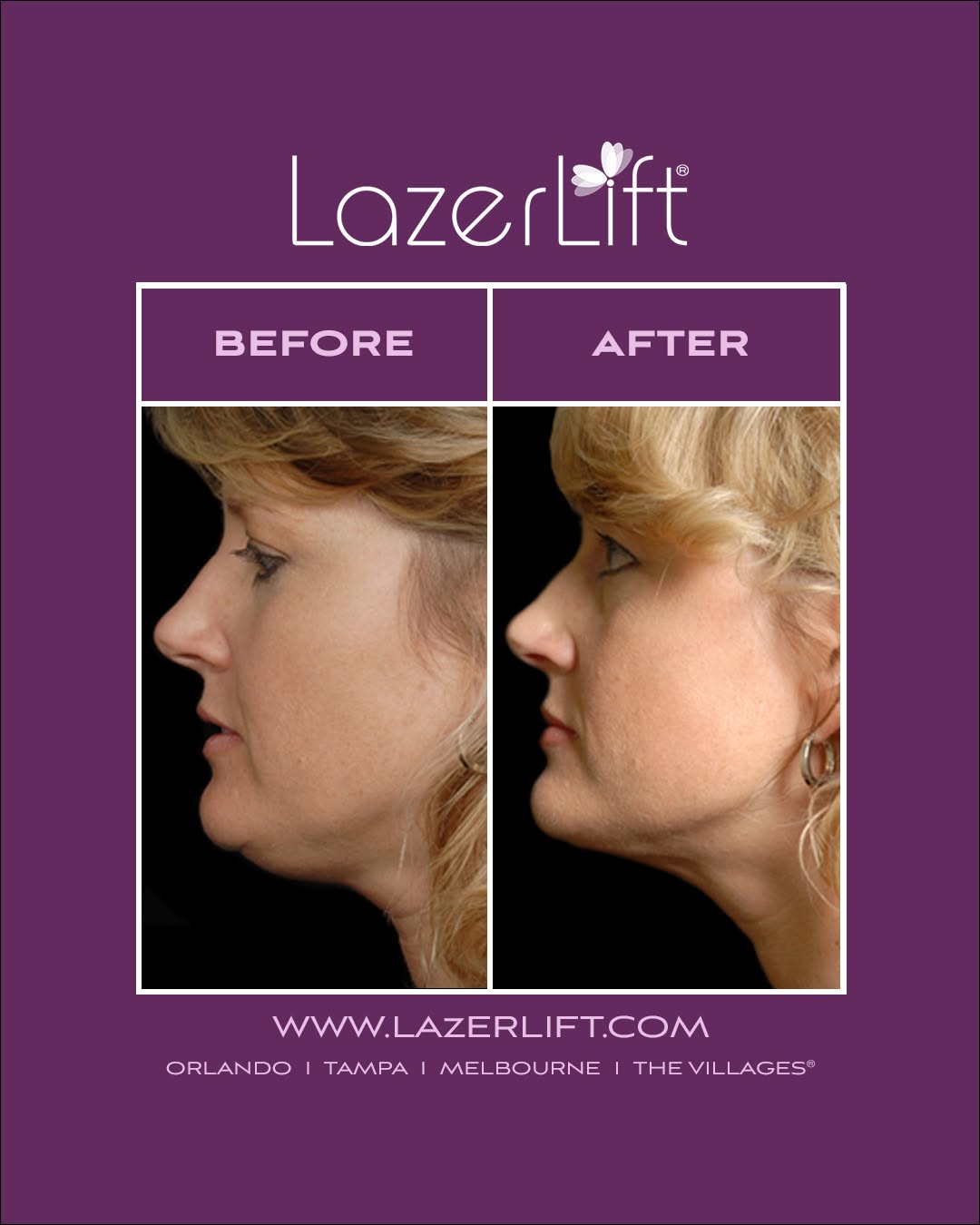 Instagram post by Dr. Roger Bassin: Real Patient Before and Afters! Check out these amazing results from undergoing LazerLift. LazerLift can tighten and lift the skin to achiev…