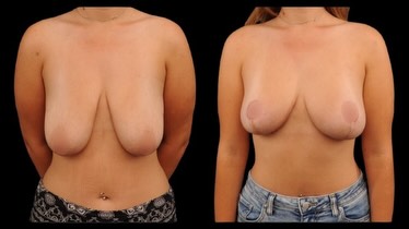 Instagram post by Dr. Rohit Jaiswal: Breast lift. No implant. One month post op.