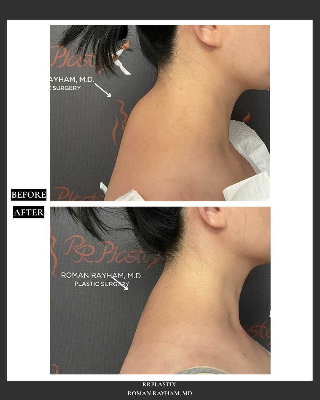 Instagram post by Dr. Roman Rayham: Before ➡️ After | Buffalo Hump Removal by Dr. Rayham✨ A buffalo hump, also known as a dorsocervical fat pad, is a buildup of excess fat at t…