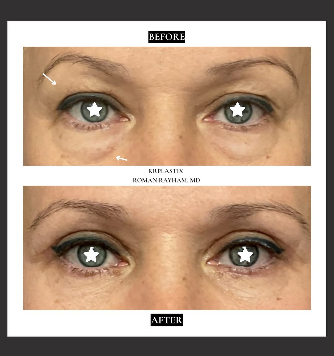 Instagram post by Dr. Roman Rayham: ✨ Upper & Lower Blepharoplasty Transformation ✨ A refreshed, brighter, and more youthful appearance without changing what makes you unique. …