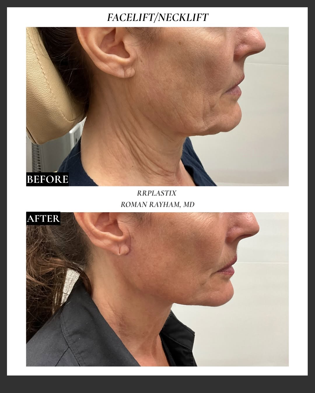 Instagram post by Dr. Roman Rayham: ✨ Before & After: Facelift + Neck Lift A beautiful, natural-looking transformation designed to restore youthful contours while maintaining t…