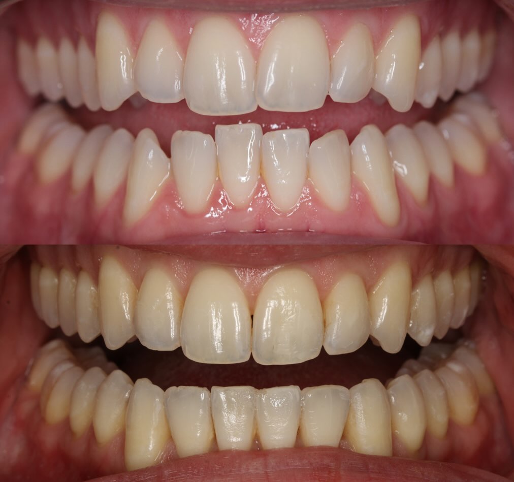 Instagram post by Dr. Ron Ayzin: ✨ When “Almost Perfect” Isn’t Good Enough… Some patients don’t want just a straighter smile. They want precision. Detail. Perfection in the …