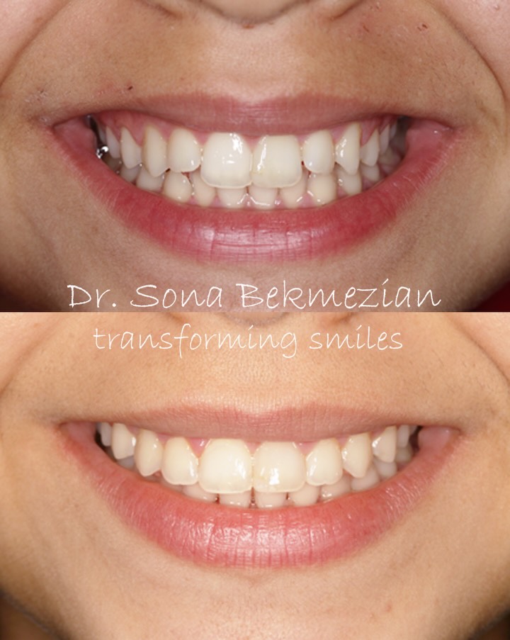 Instagram post by Dr. Ron Ayzin: ✨ Braces don’t just straighten teeth — they can change the way you feel about yourself. ✨ Sometimes, the biggest transformation isn’t what y…