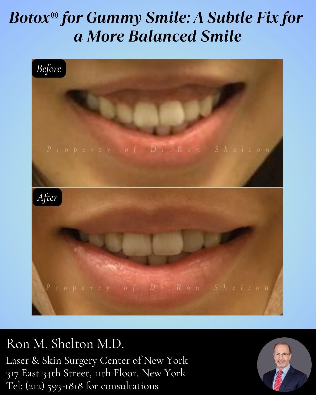 Instagram post by Dr. Ron Shelton: A More Balanced Smile with Botox® For some people, smiling reveals more of the upper gum than they'd like — a common concern known as a "gum…