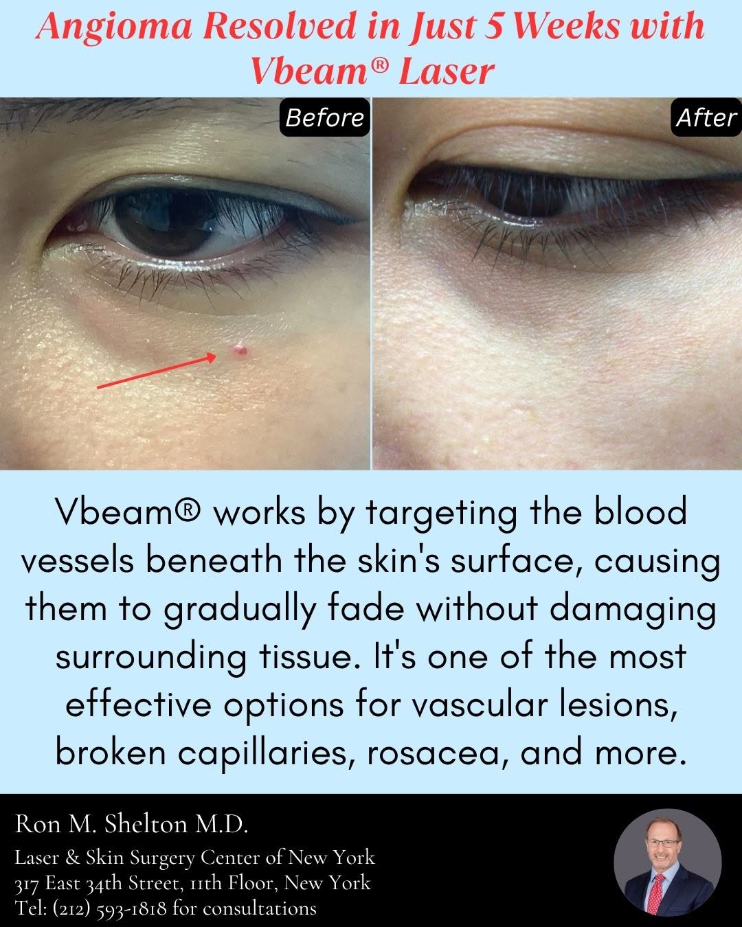 Instagram post by Dr. Ron Shelton: Angiomas; those small, red vascular bumps, can be frustrating to live with, but they don't have to be permanent. This patient came to Dr. Ro…