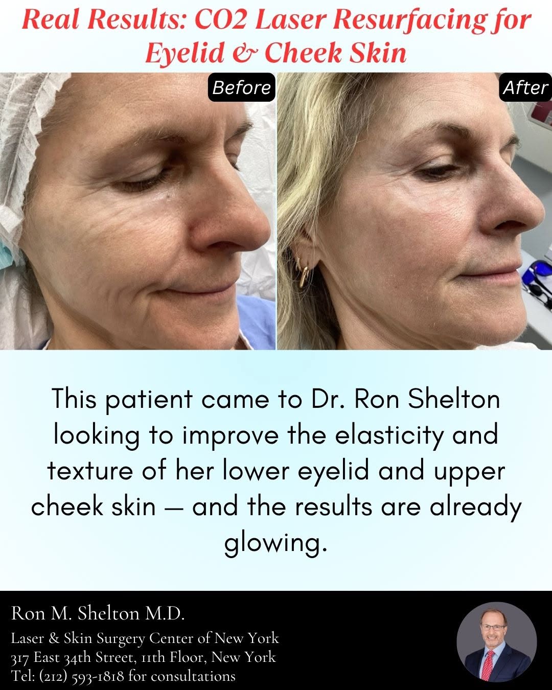 Instagram post by Dr. Ron Shelton: Real Results: CO2 Laser Resurfacing for Eyelid & Cheek Skin Just 3.5 weeks post-treatment, and the transformation speaks for itself! This pa…