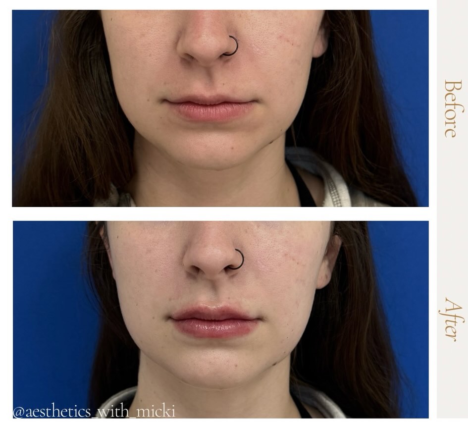 Instagram post by Dr. Ronald A. Krueger: Fun little lip transformation with one of my faves💋✨ I used @evolyssebyevolus Smooth to add soft, juicy volume while keeping everything nat…