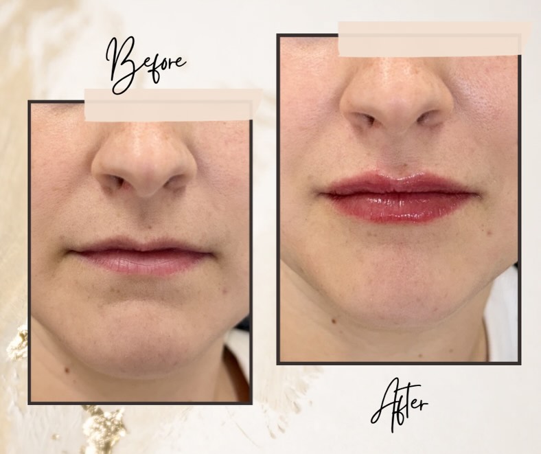 Instagram post by Dr. Ronald A. Krueger: Loved creating these lips 👄 using @evolyssebyevolus This patient was initially nervous, but we had an in depth consultation about our mutua…