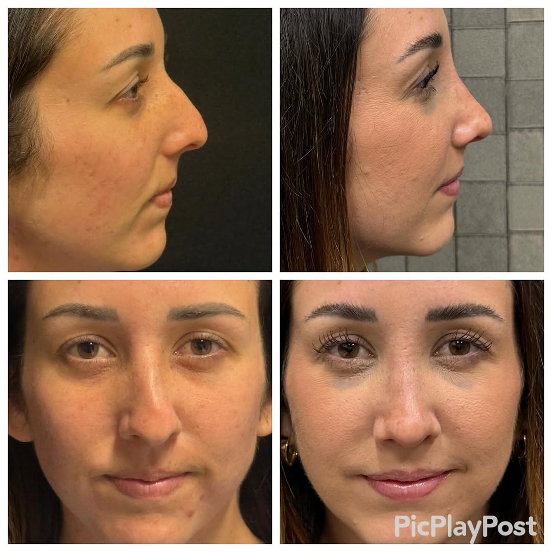 Instagram post by Dr. Ronald J. Edelson: Closed rhinoplasty two weeks out! #dredelson #closedrhinoplasty #sandiegorhinoplssty