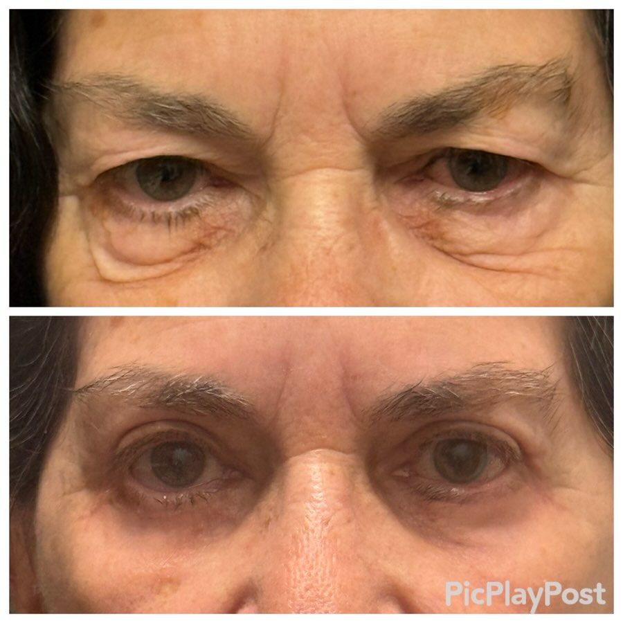 Instagram post by Dr. Ronald J. Edelson: People have requested to see the previous eyelid patient after she was healed. Ask and you shall receive! #dredelson