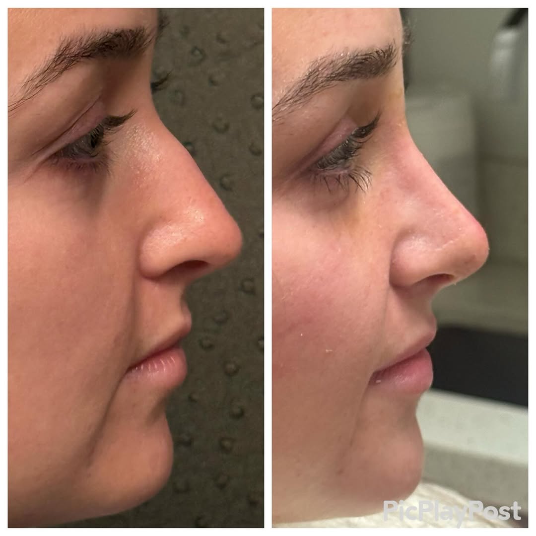 Instagram post by Dr. Ronald J. Edelson: Last week’s rhinoplasty. Cute as can be! #dredelson #closed rhinoplasty #scarlessrhinoplastysandiego
