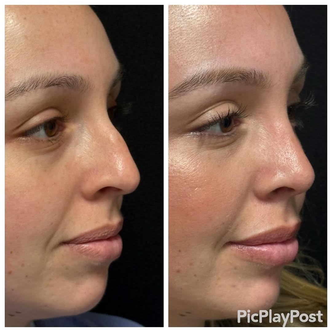 Instagram post by Dr. Ronald J. Edelson: Two months after rhinoplasty. Came to me because I was the only surgeon who would do it closed! #dredelson #closedrhinoplasty #scarlessrhino…