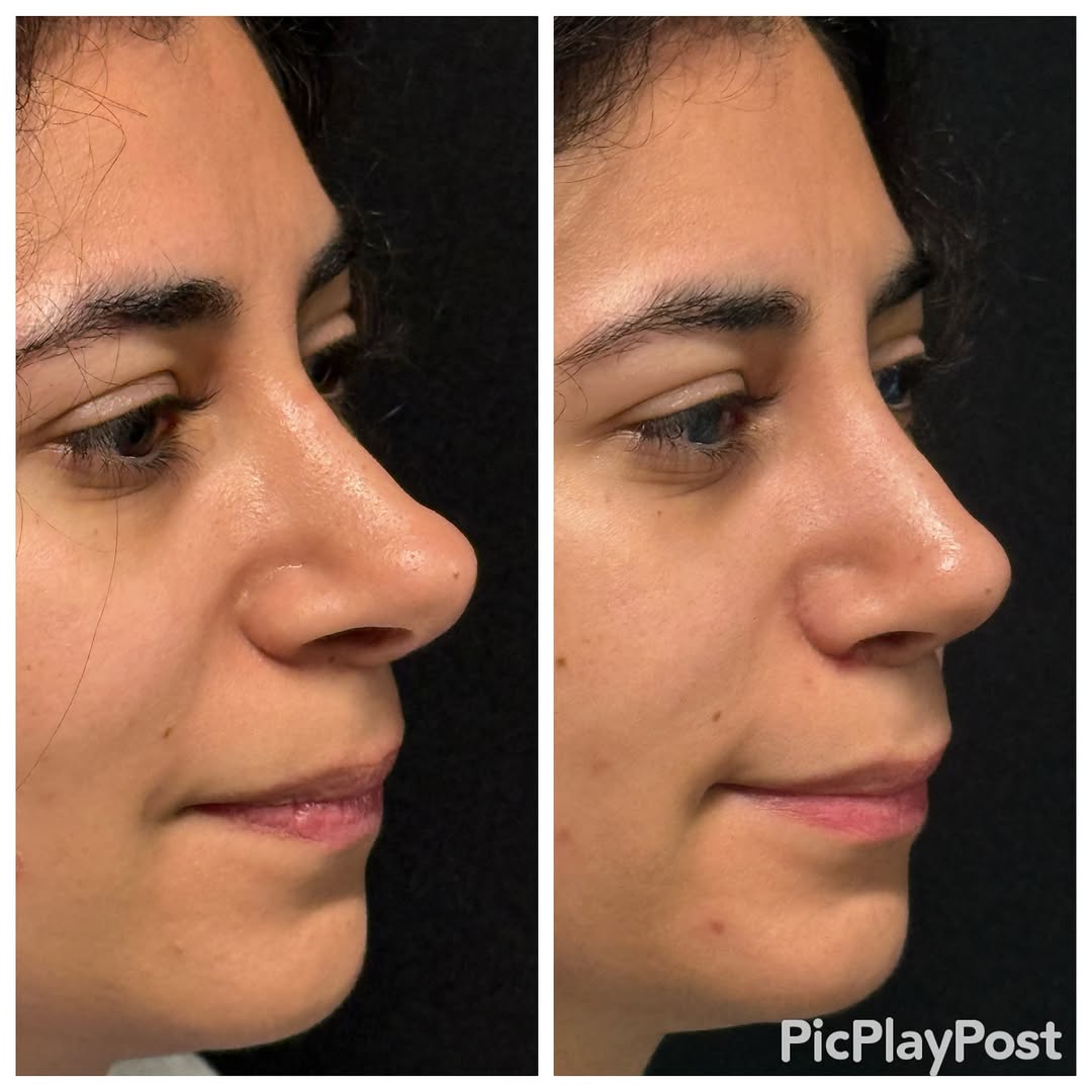 Instagram post by Dr. Ronald J. Edelson: Revision rhinoplasty done as a closed rhinoplasty. Nose originally had septal extension graft.#dredelson#scarlessrhinoplasty#revisionrhinopl…
