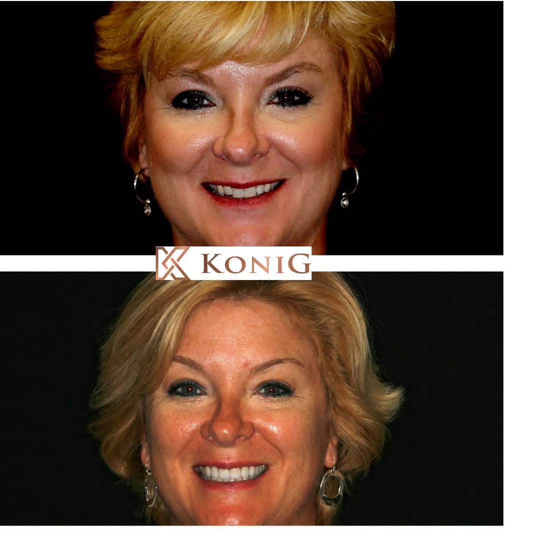 Instagram post by Dr. Ronald Konig DDS: Most patients do not realize their bite and jaw alignment affects their facial profile, facial symmetry, and also cause TMJ and cervical pai…
