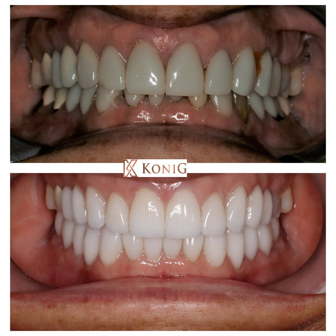 Instagram post by Dr. Ronald Konig DDS: Damaged teeth and/or TMJ pain from a misaligned bite. Correcting the bite and alignment prior to restorative care and cosmetic dental care, …