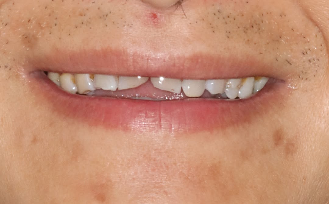 Instagram post by Dr. Ronald Konig DDS: TMJ Does Not Have to Be About Pain TMJ is very often only associated with TMJ Pain. This photo shows a young man with no TMJ pain, however, …
