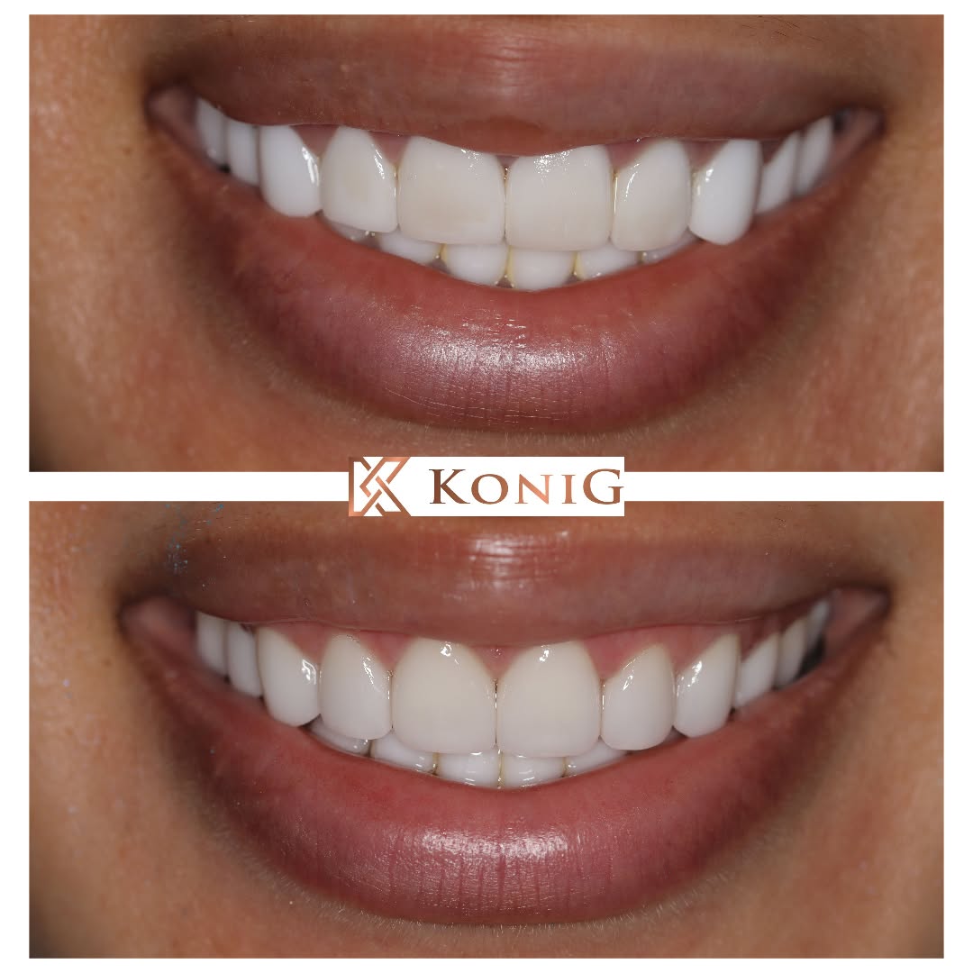 Instagram post by Dr. Ronald Konig DDS: Many patients worry about porcelain veneers not looking natural. This young lady had her veneers done elsewhere and was upset at how bulky, …