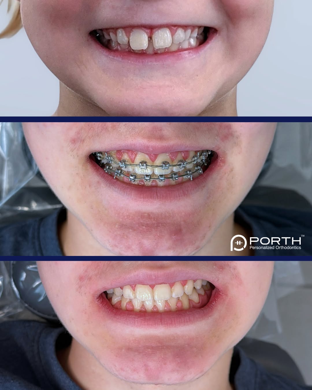 Instagram post by Dr. Rooz Khosravi, D: Progress worth celebrating! ✨ Orthodontic treatment is all about small improvements that add up over time. Every adjustment, every app…