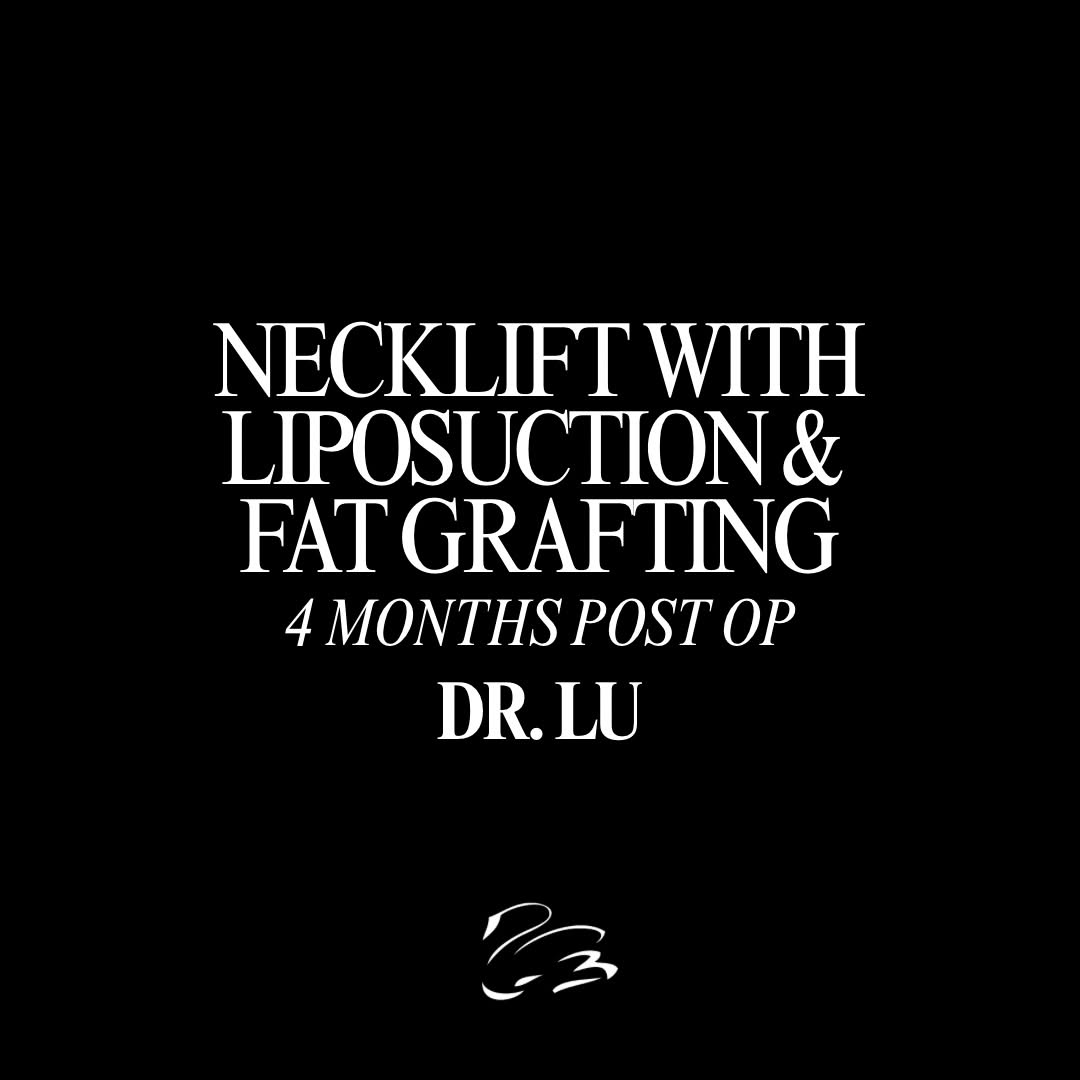 Instagram post by Dr. Rosiane A. Roeder: What a transformation! ✨ This neck lift with liposuction and fat grafting to the earlobes by Dr. Lu showcases the beautiful results that can…