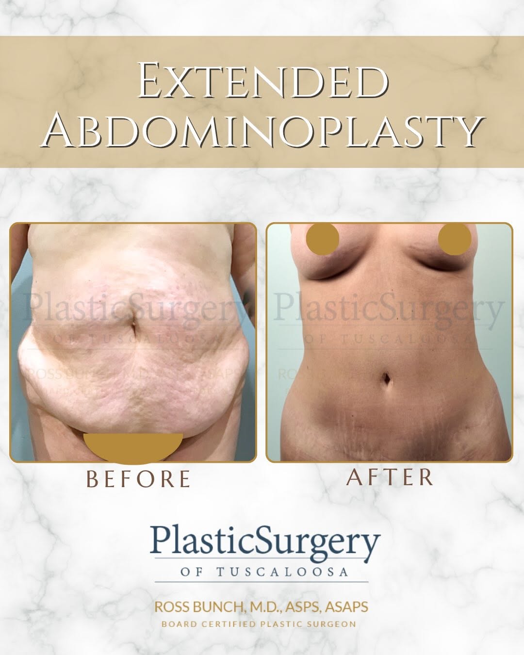 Instagram post by Dr. Ross E. Bunch: Three years later... and she’s back. 🤍 An Extended Abdominoplasty helped her achieve the confidence she had been dreaming of, and after enj…