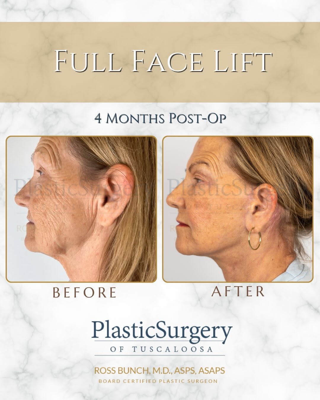 Instagram post by Dr. Ross E. Bunch: Turn back the clock- without turning into someone else. ✨ A beautiful transformation and confidence boost to match! This full facelift resul…