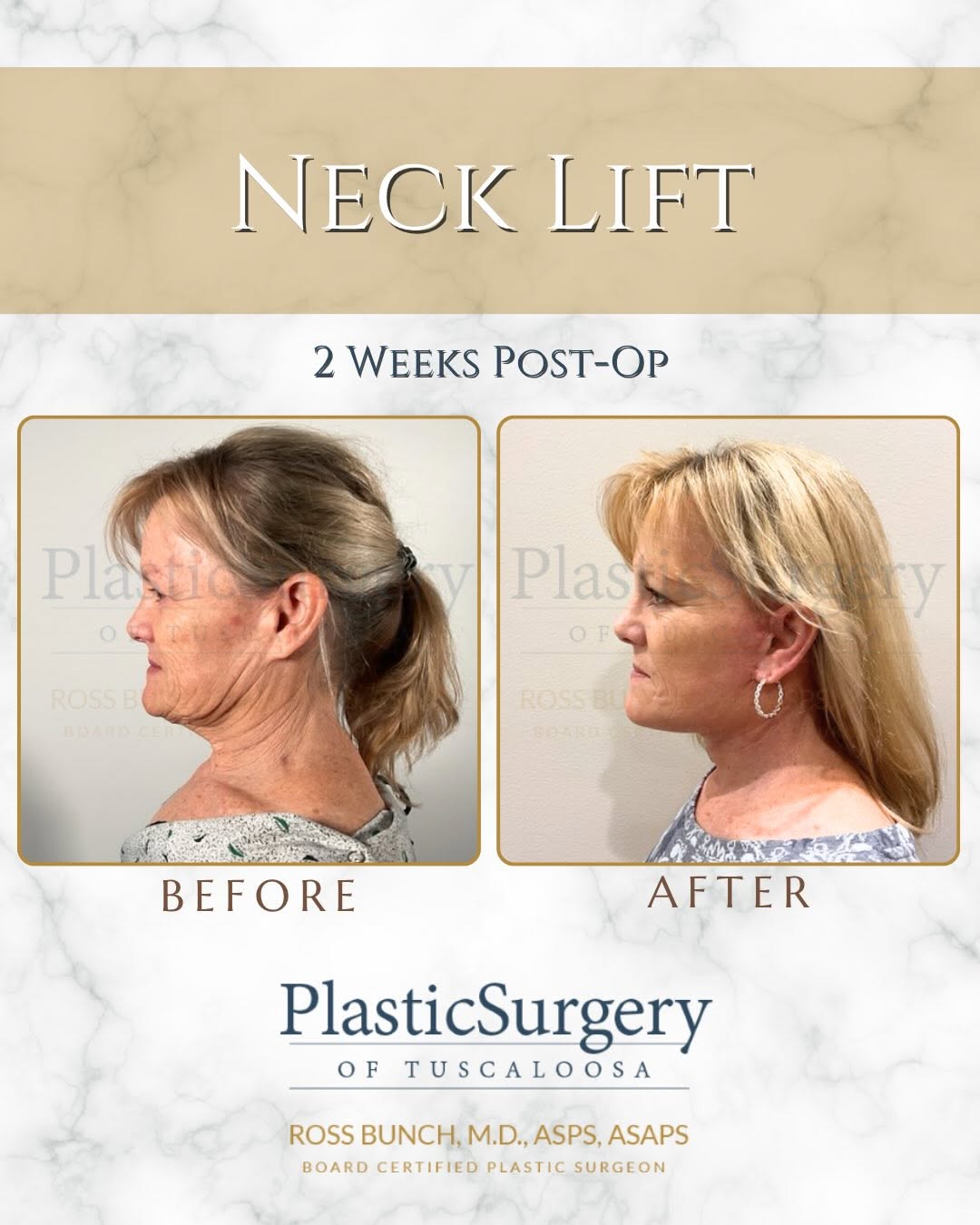 Instagram post by Dr. Ross E. Bunch: Two weeks post-op and the transformation is already taking shape ✨ A neck lift helps redefine the jawline, reduce excess skin, and create a …