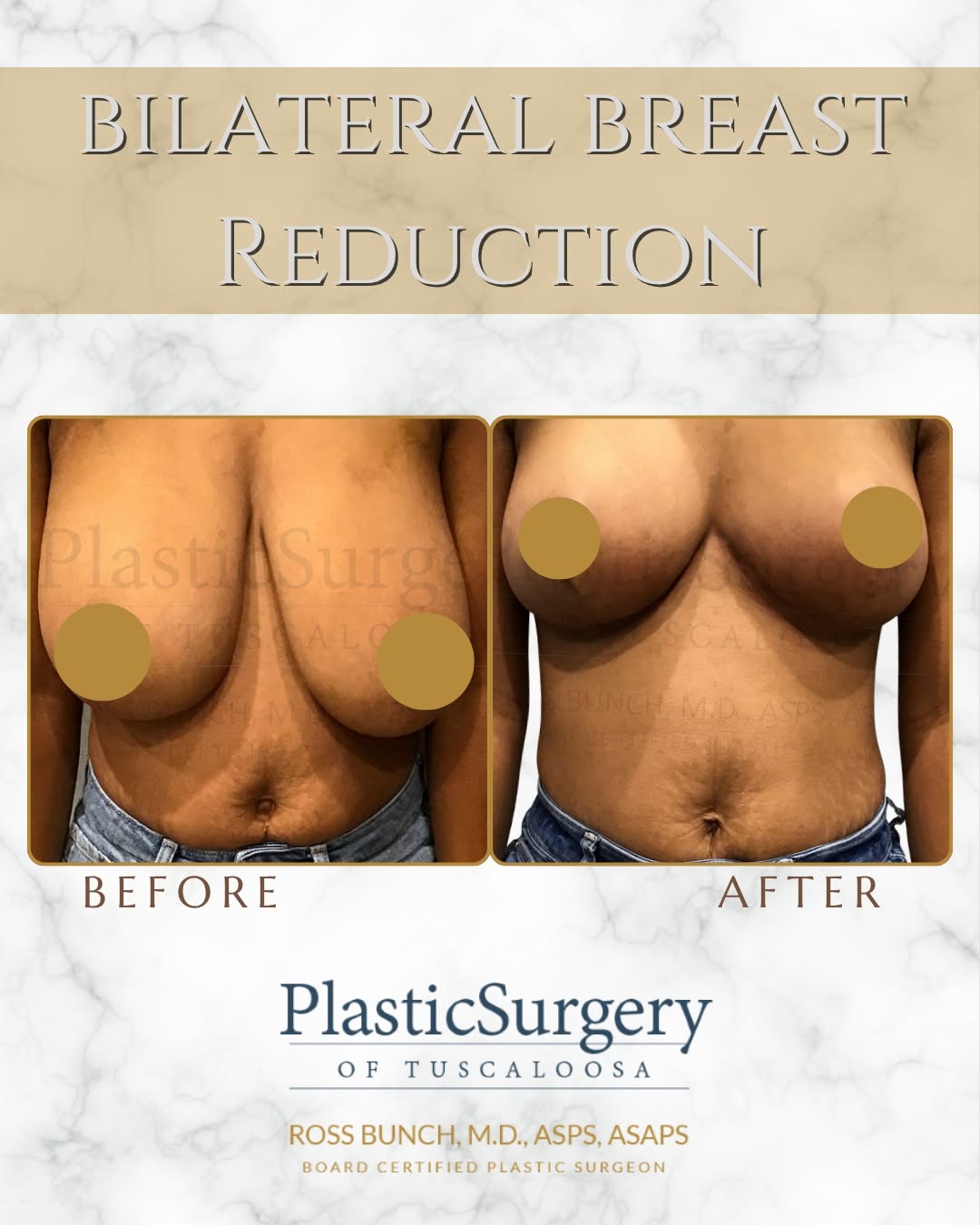 Instagram post by Dr. Ross E. Bunch: ✨Bilateral Breast Reduction ✨ Breast reduction surgery can do more than change your appearance — for many patients, it can also provide mean…