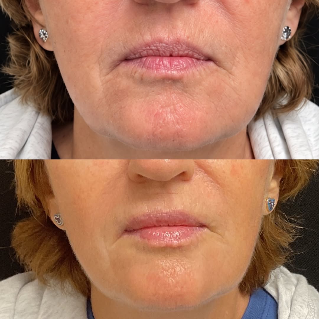 Instagram post by Dr. Roxanne Sylora: Perioral rejuvenation is about more than treating the lines themselves. ✨ For this patient, we combined SKINVIVE™ with lip filler to address…