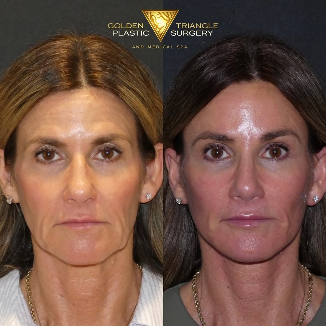 Instagram post by Dr. Roy A. David: Just under 2 months post op from a deep plane facelift and rhinoplasty . Not many surgeons can combine these two procedures in one operation…