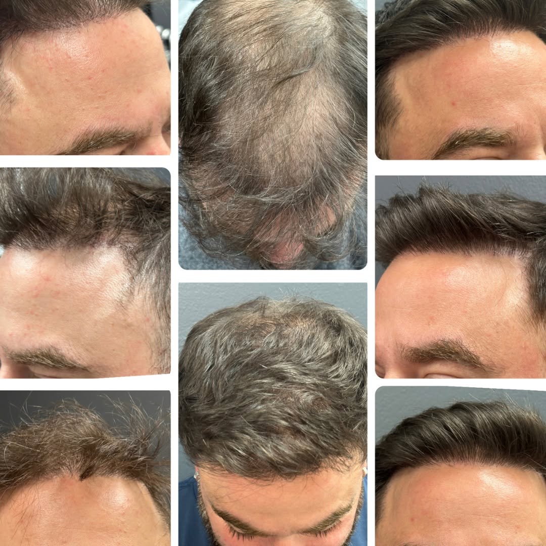 Instagram post by Dr. Roy Stoller: Every angle. Every area. Completely transformed.✨ These real FUE results from Dr. Stoller show what's possible from every perspective—hairli…