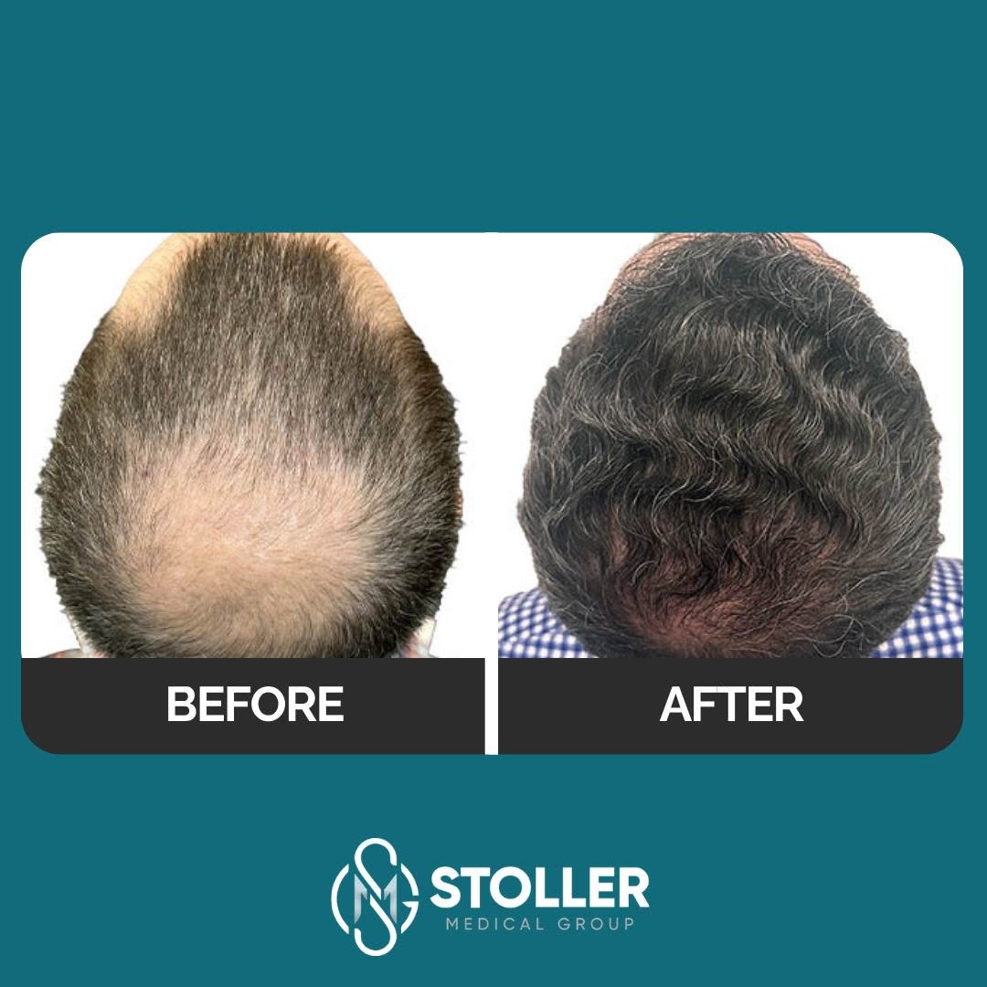 Instagram post by Dr. Roy Stoller: Crown restoration done right.👑 This is one of the most dramatic crown transformations we've seen—from significant thinning and visible scal…