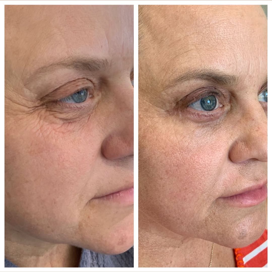 Instagram post by Dr. Roya Ghafouri: Sometimes our eyes just don’t do us justice….and this was the case in this stunning 54 year old patient of mine. She had lost almost 75 lbs …