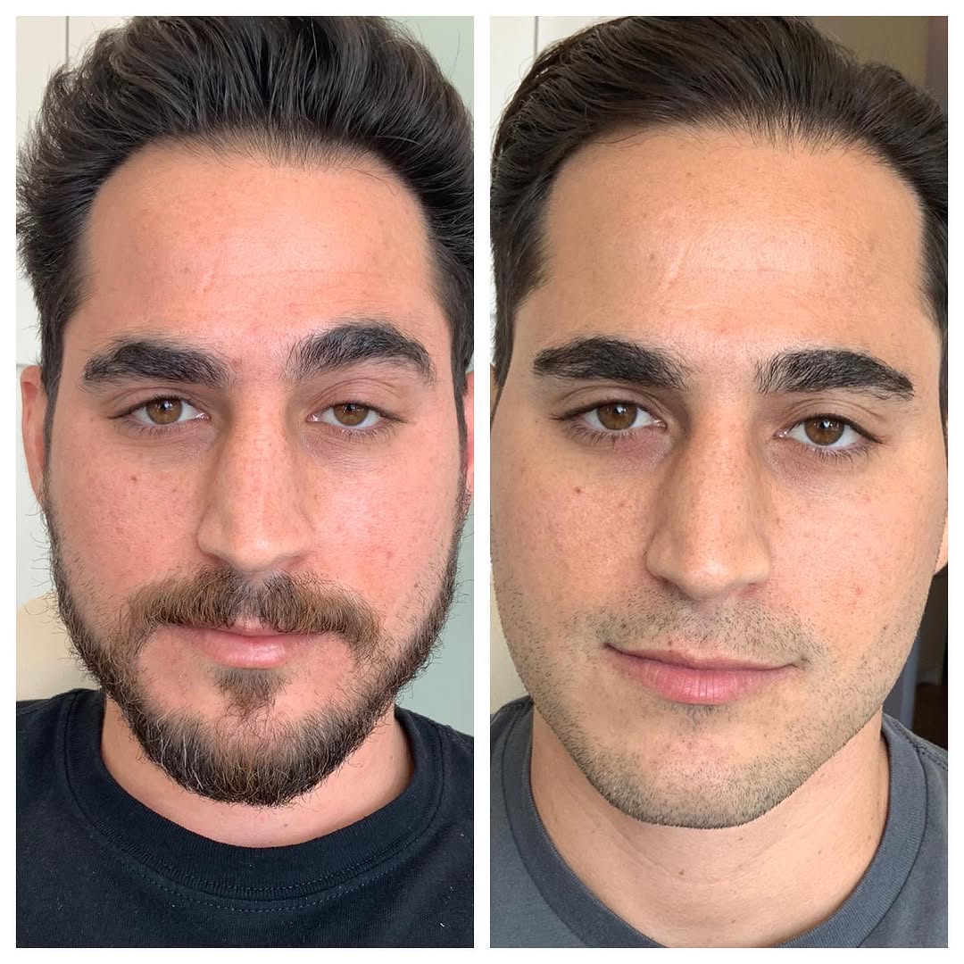 Instagram post by Dr. Roya Ghafouri: It’s the little tweaks and details that make a big difference in some people’s appearances….here we did a left upper eyelid internal ptosis …