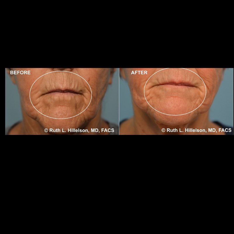 Instagram post by Dr. Ruth L. Hillelson: Morpheus8 of the mouth (upper and lower lips) 2 months after procedure. The Morpheus8 uses radio frequency (RF) and microneedling to treat s…
