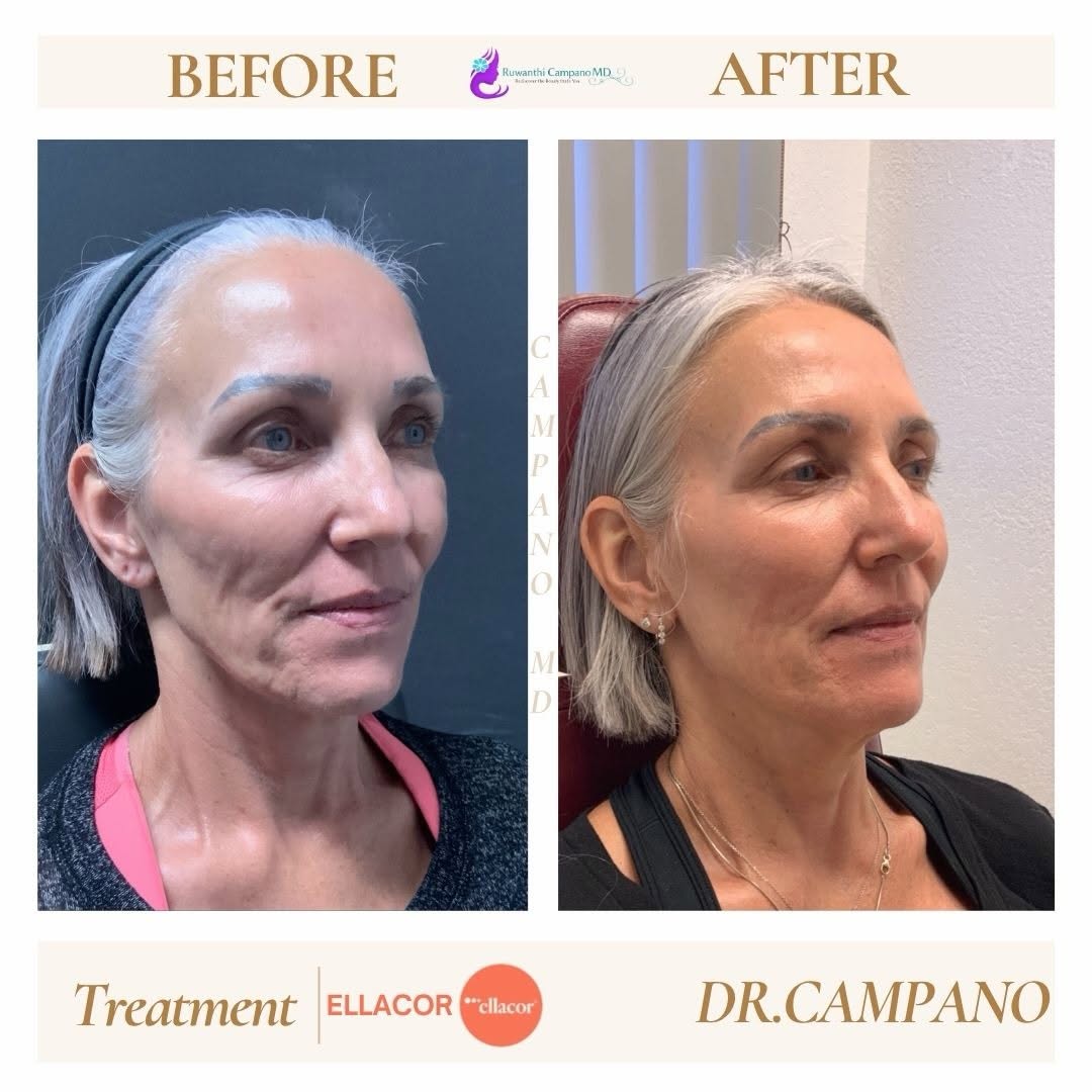 Instagram post by Dr. Ruwanthi Campano: By popular demand 🤍 Ellacor before & after. BeforeAndAfter #Ellacor #palmdale #Aesthetics