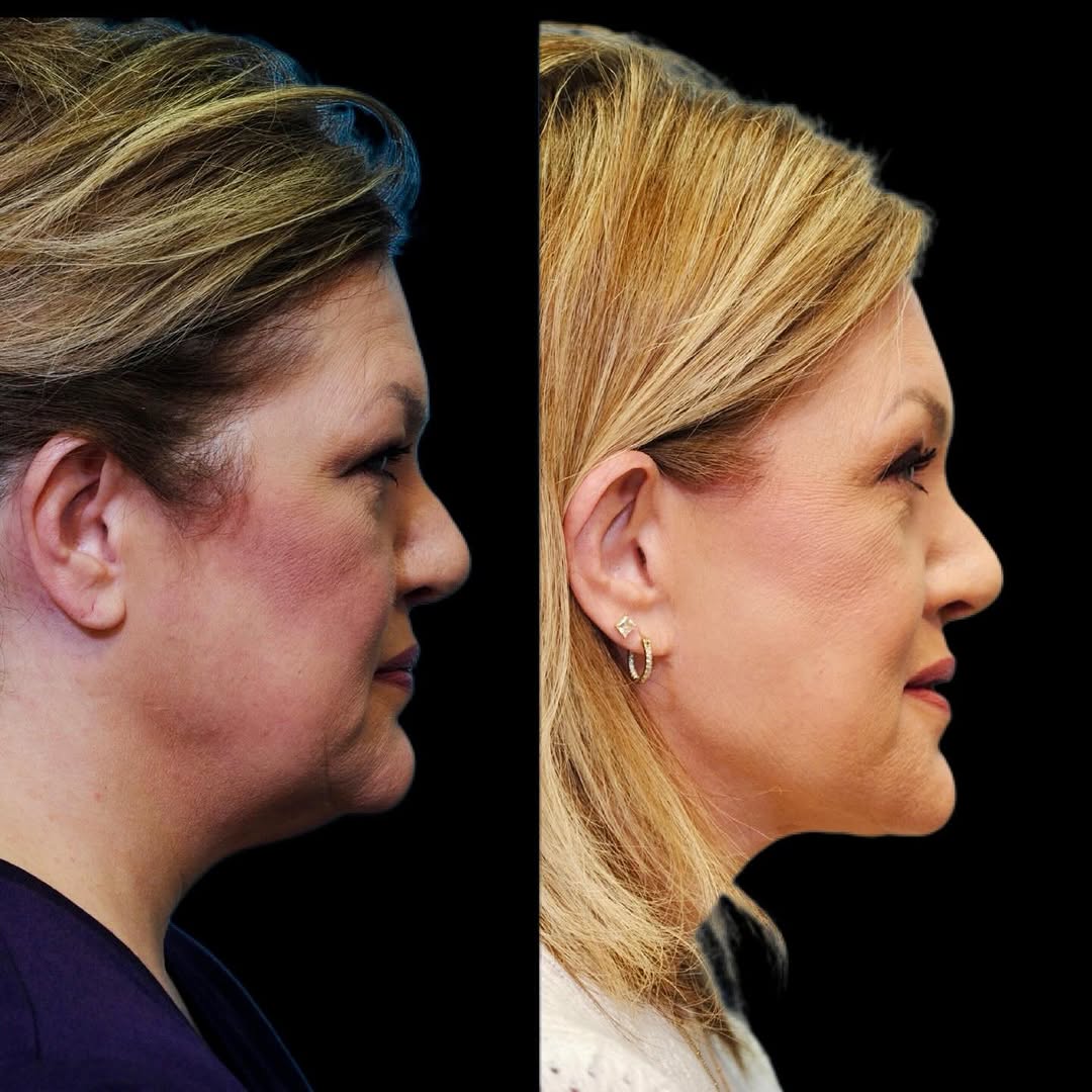 Instagram post by Dr. Ryan Chastant: Starting the weekend with fabulous results!✨ 8 months post-op from a lift & fill facelift, brow lift, and upper & lower blepharoplasty perfo…