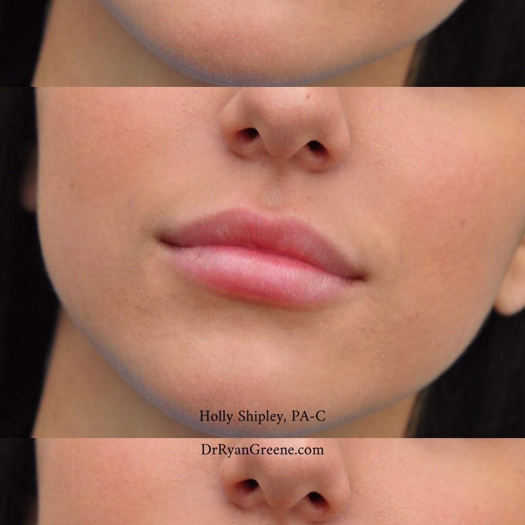 Instagram post by Dr. Ryan Greene: We are obsessed🤩 Holly’s schedule is booking up for the remainder of the month! Feel free to give our office a call to set up your lip fill…