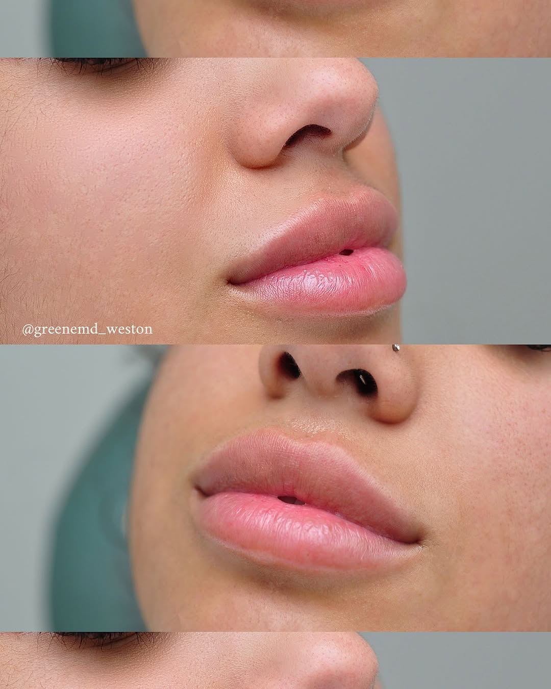 Instagram post by Dr. Ryan Greene: How could we not post these lips done by Dr. Greene?! 🔥