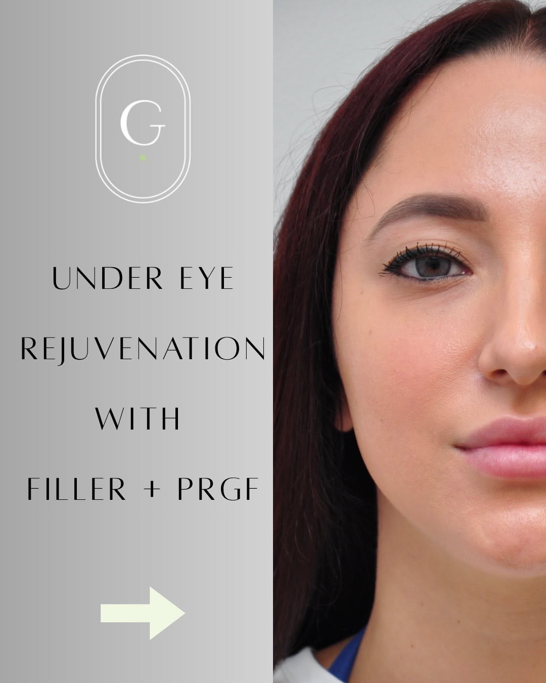 Instagram post by Dr. Ryan Greene: Under-eye transformation ✨ We started with precise filler placement to restore volume and soften a deep tear trough for immediate improvemen…